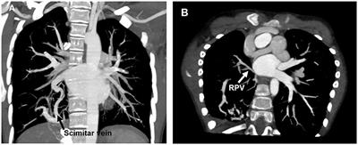 Treatment and prognosis of Scimitar syndrome: A retrospective analysis in a single center of East China